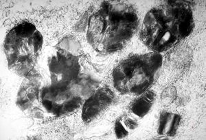 M, 17y. | Fabry disease - skin M, 17y. | Fabry disease - skin